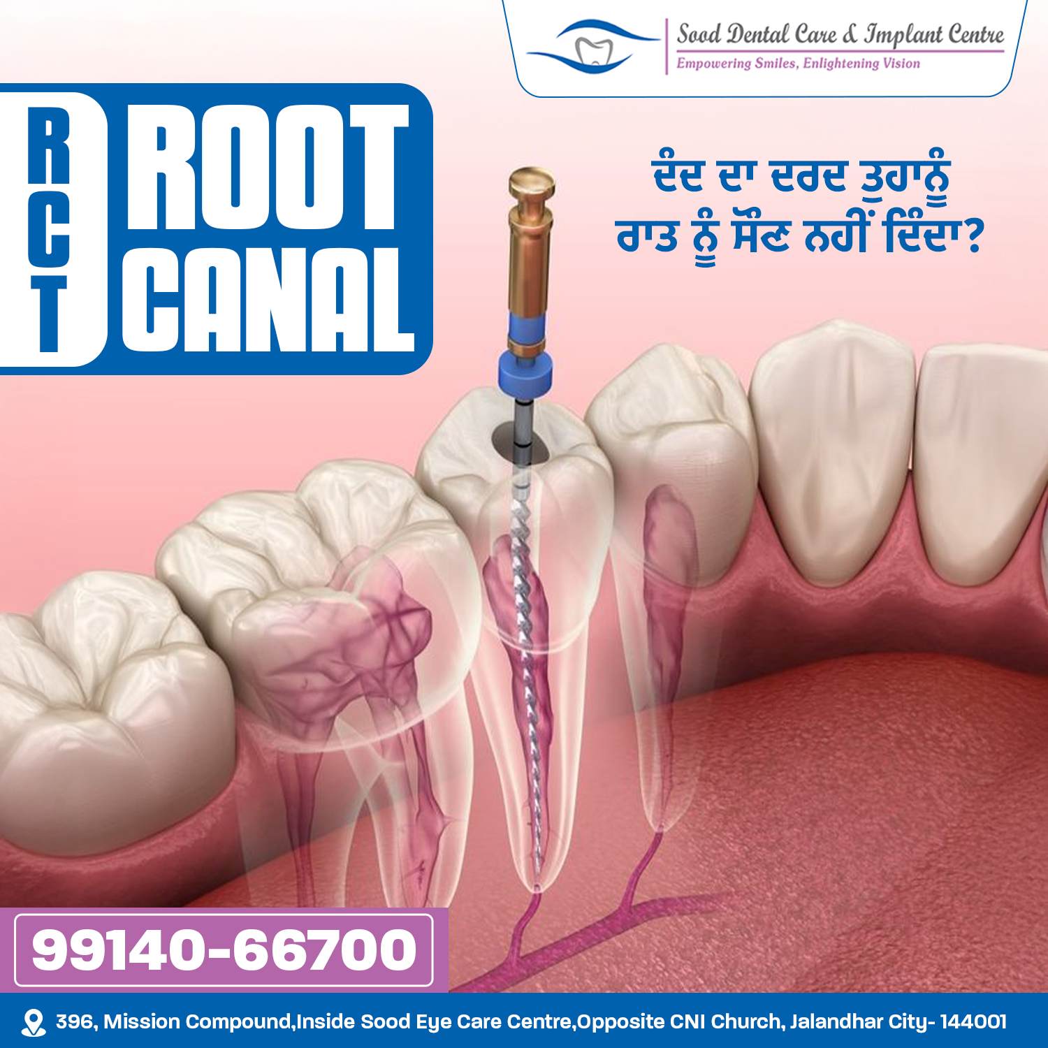 "Best root canal treatment in Jalandhar by Dr. Isha Sood"